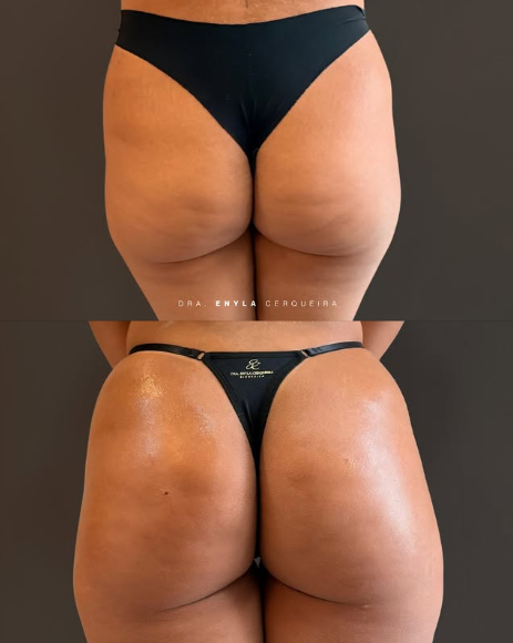 Antes e depois de tratamento estético na região glútea