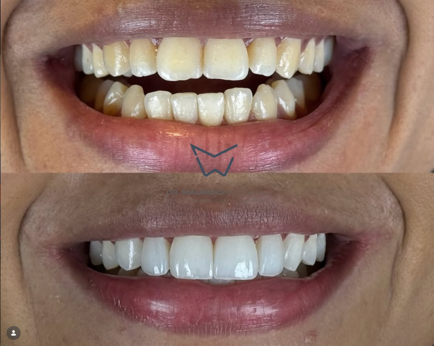 Antes e depois de tratamento odontológico na Oral Face