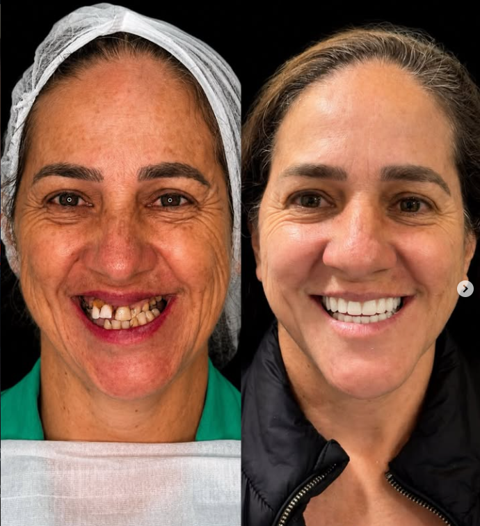 Antes e depois de transformação do sorriso realizada pela Oral Face